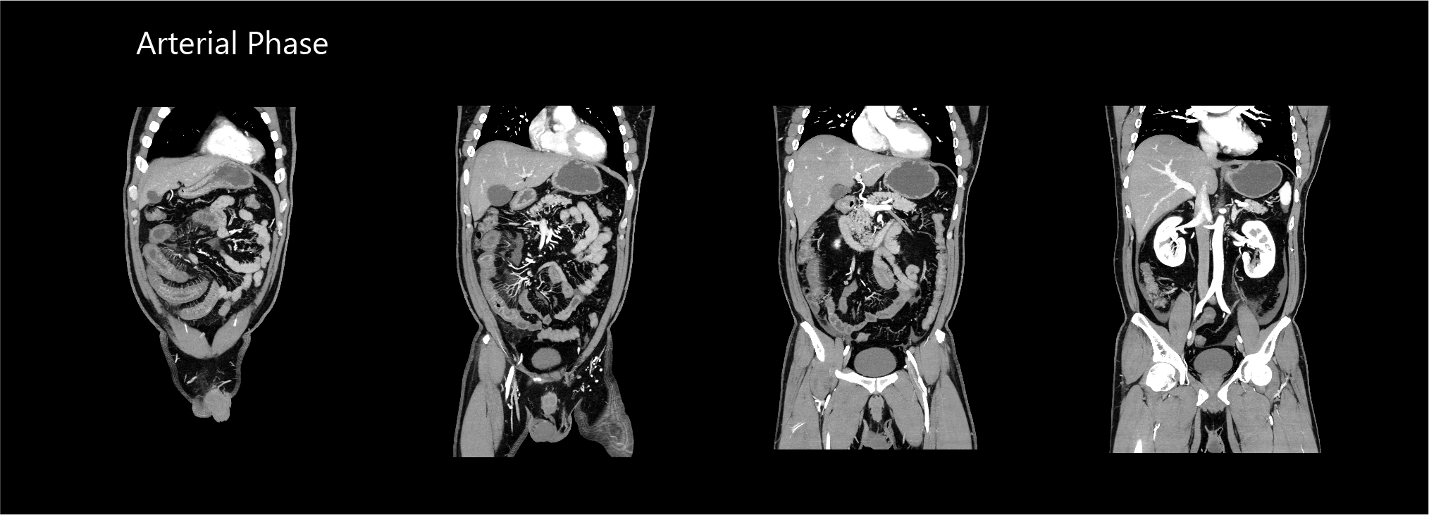 AiCE Abdomen and Pelvis