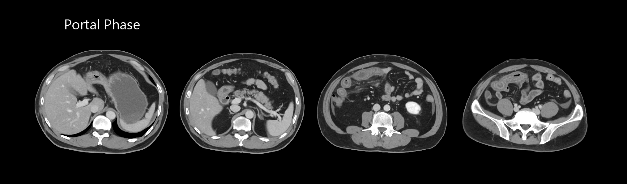 AiCE Abdomen and Pelvis