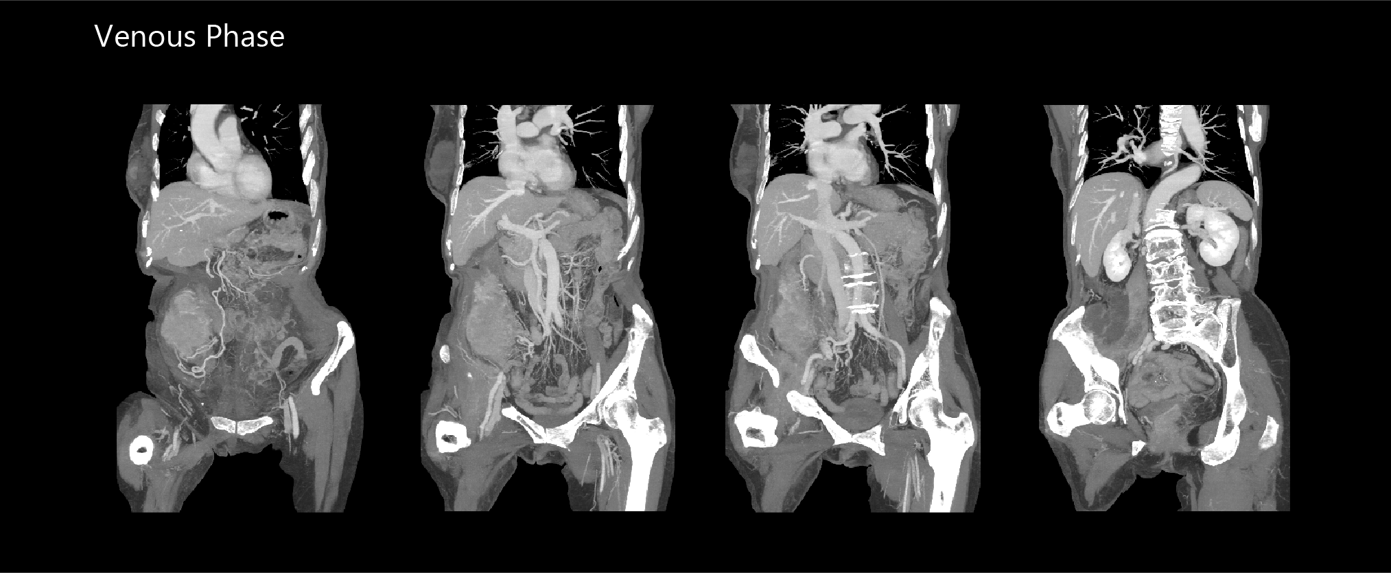 AiCE Abdomen & Pelvis