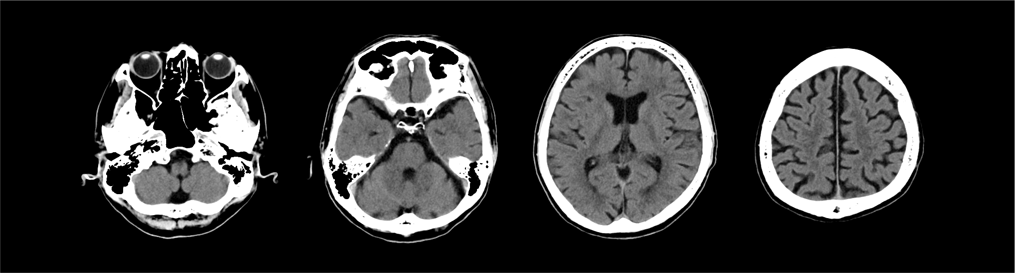 Advanced intelligent Clear-IQ Engine (AiCE) Brain