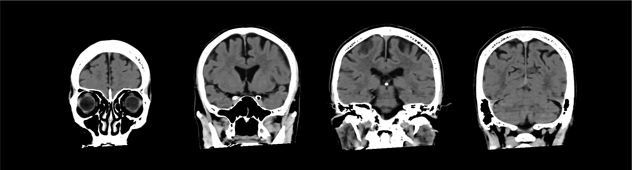 Advanced intelligent Clear-IQ Engine (AiCE) Brain