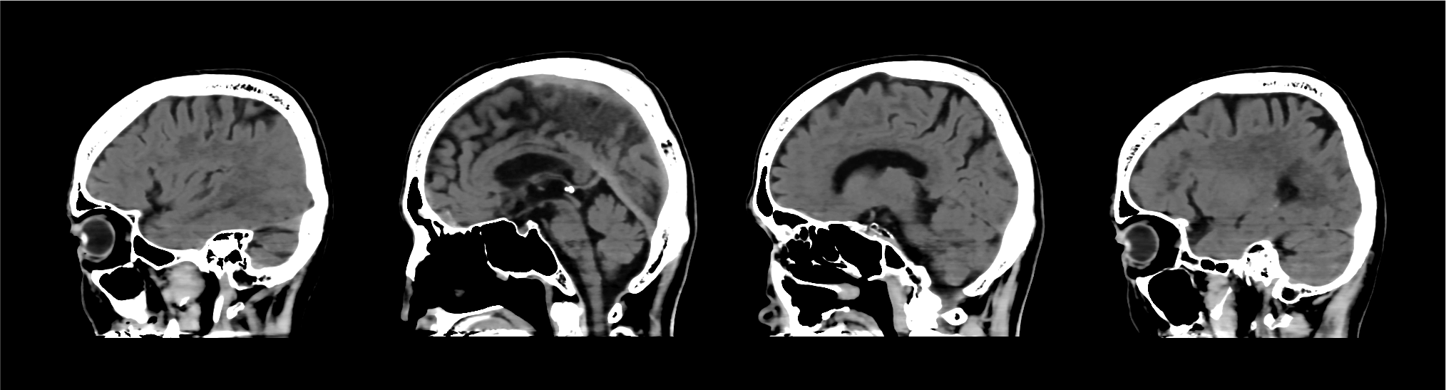 Advanced intelligent Clear-IQ Engine (AiCE) Brain