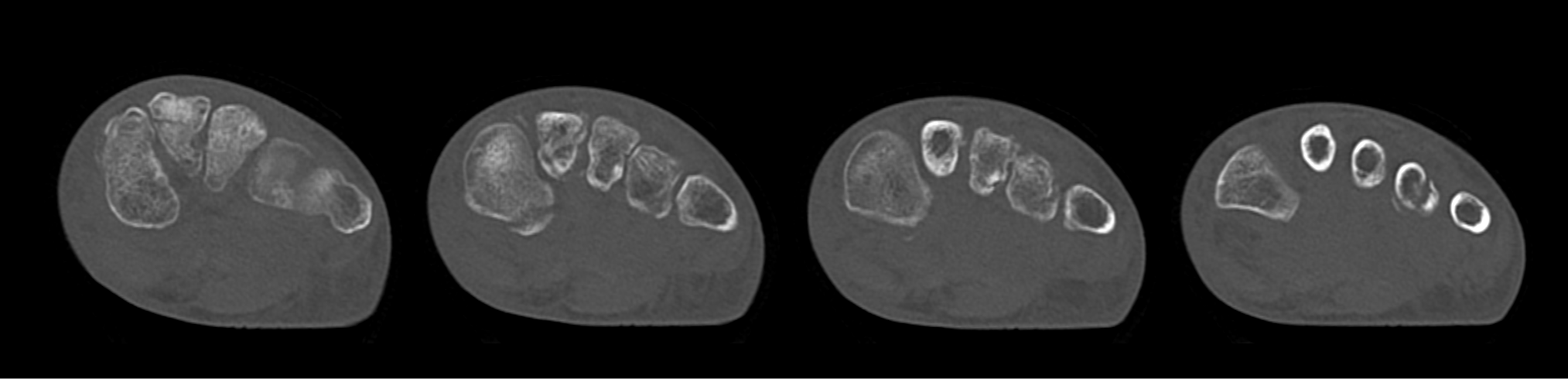 Foot Fracture