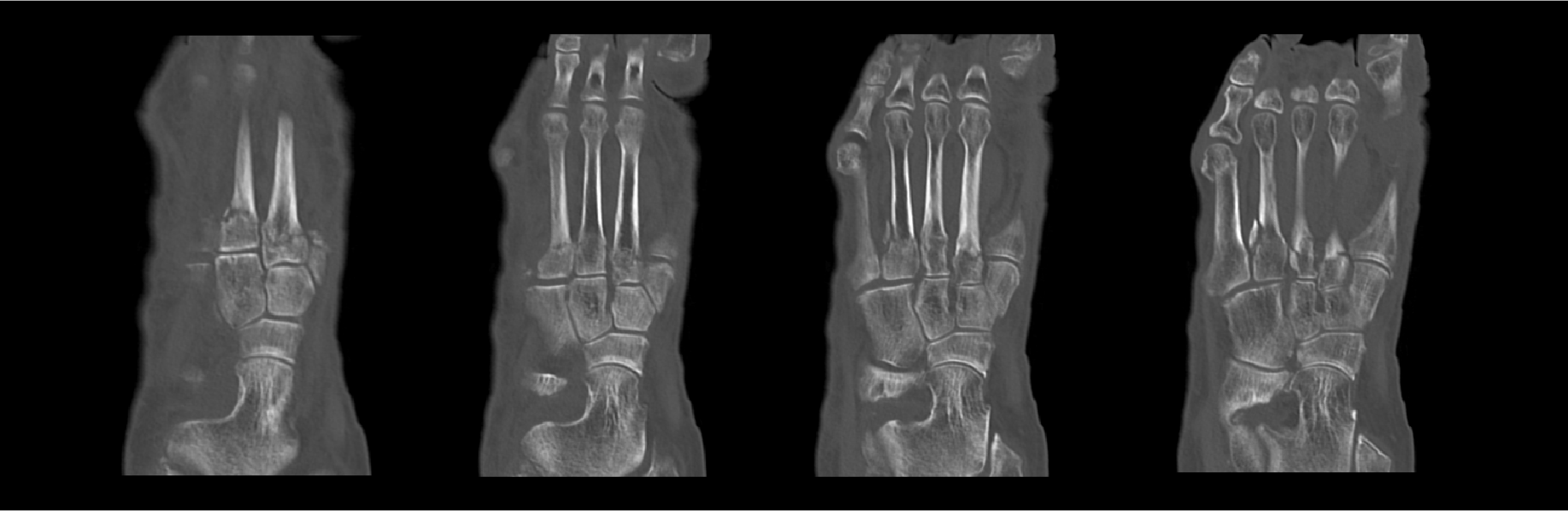 Foot Fracture