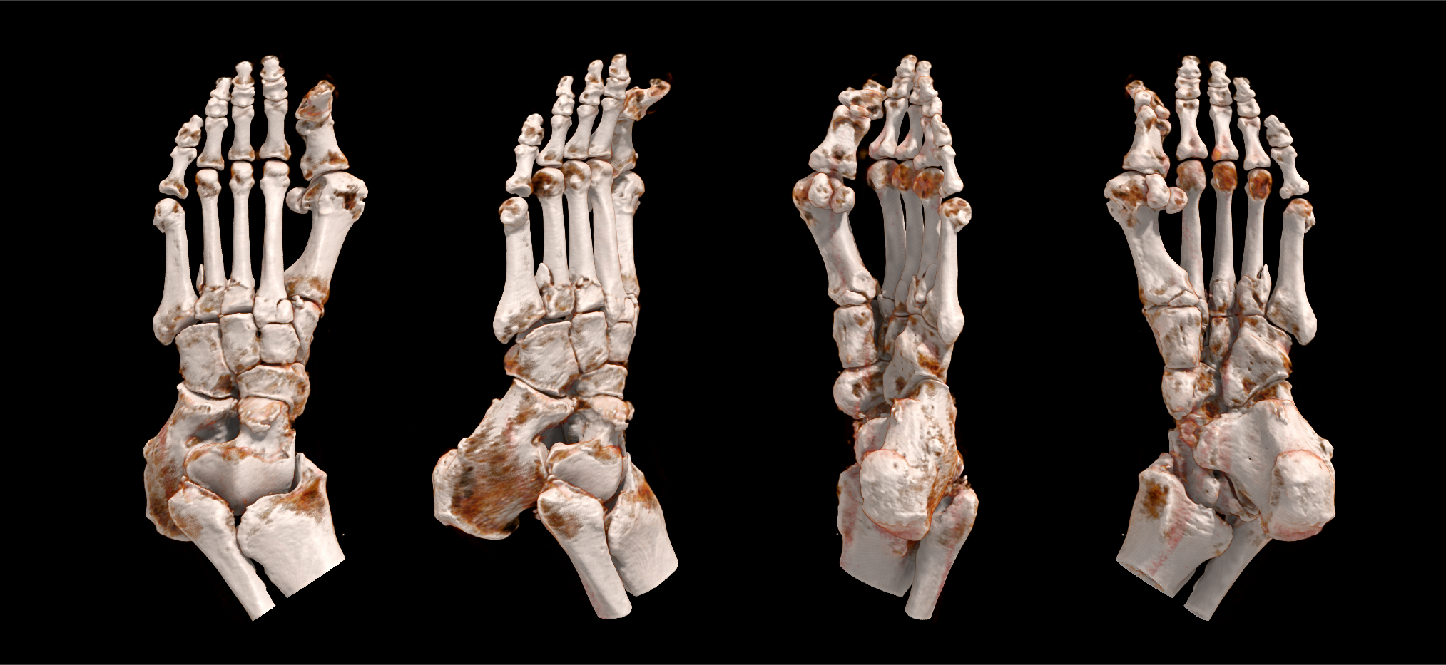 Foot Fracture