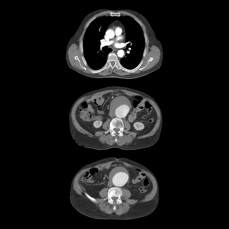 Whole Aorta CTA Body Imaging 6