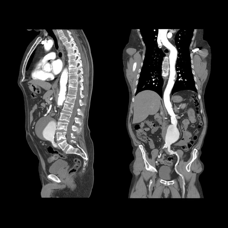 Whole Aorta CTA Body Imaging 6
