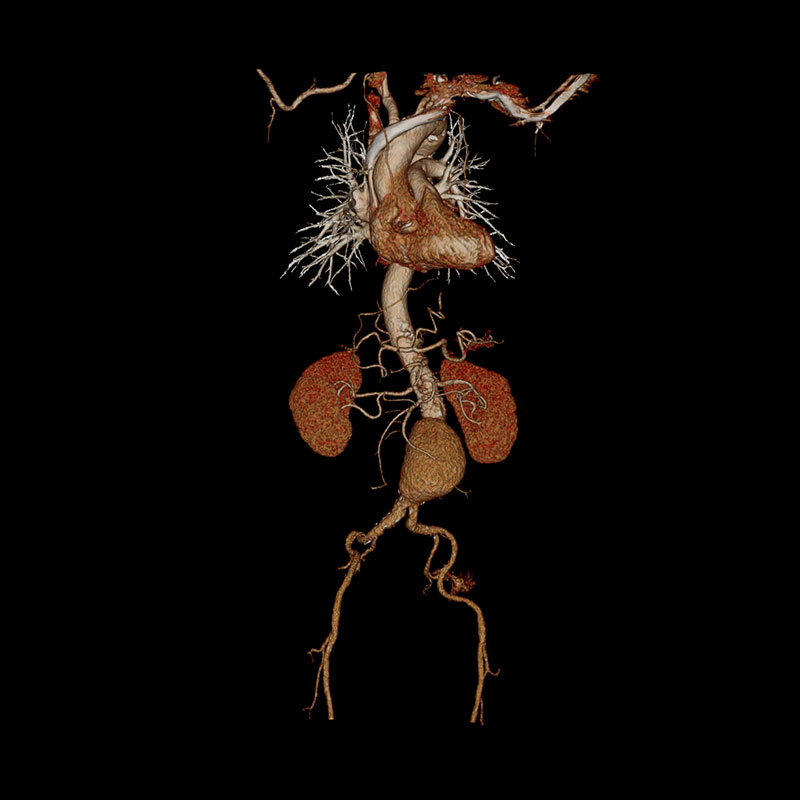 Whole Aorta CTA Body Imaging 6