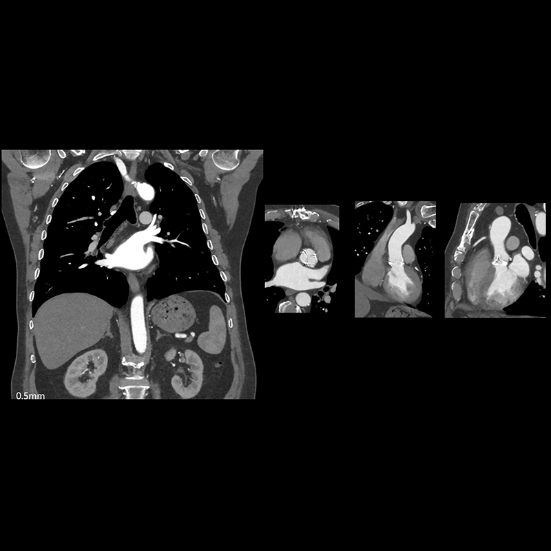 Aorta CTA Body Imaging 2