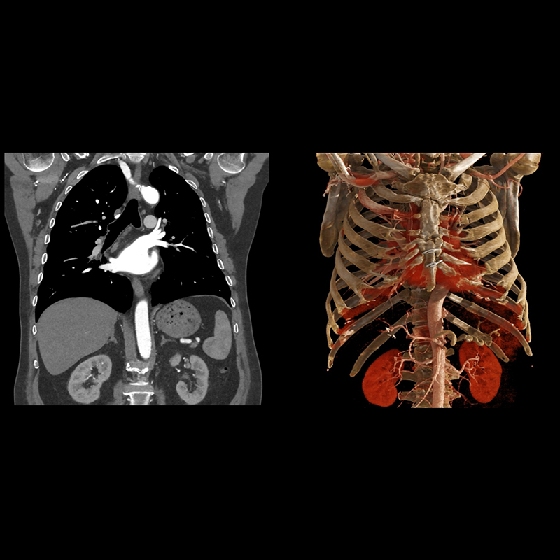 Aorta CTA Body Imaging 2
