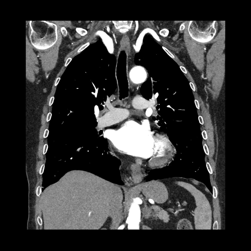 Chest CTA Body Imaging 1