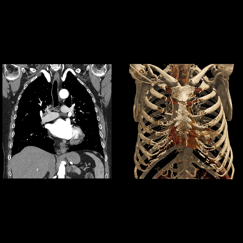 Chest CTA Body Imaging 1