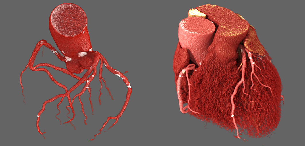 Cardiac Cardiac - 3 vessel disease