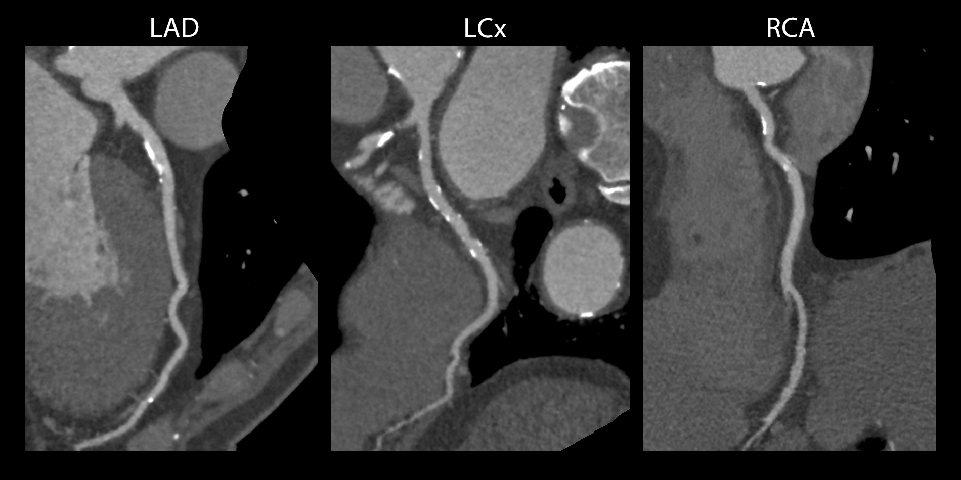 Cardiac Cardiac - 3 vessel disease