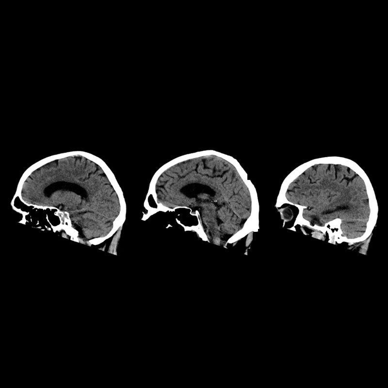 Brain Head & Neck 3