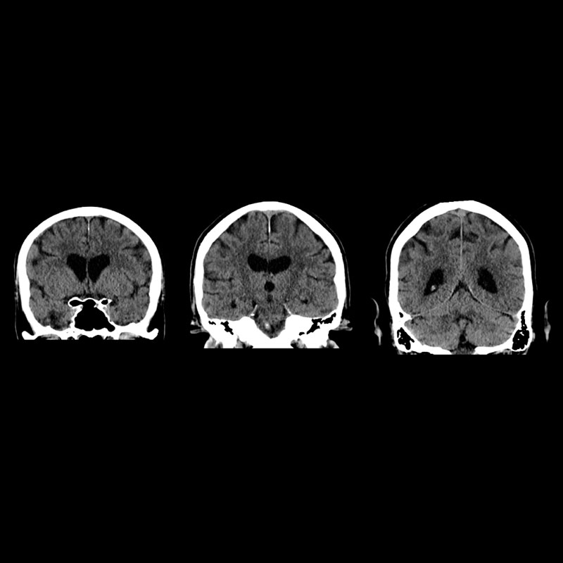 Brain Head & Neck 3