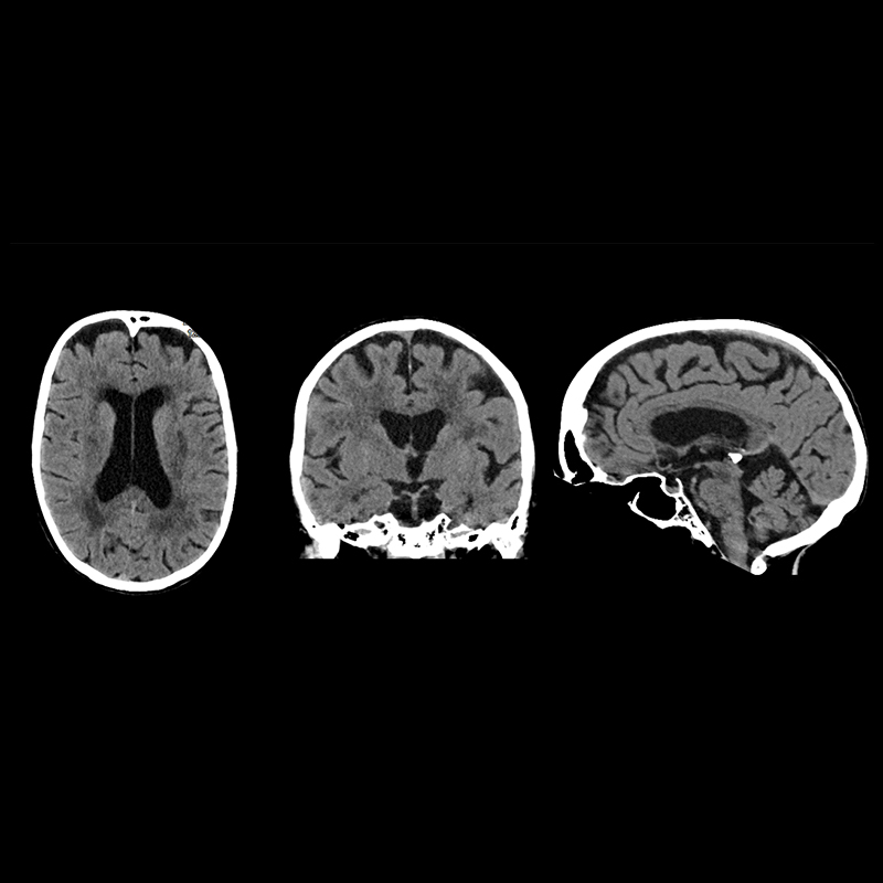 Routine brain Head & Neck 1