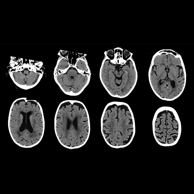 Routine brain Head & Neck 1