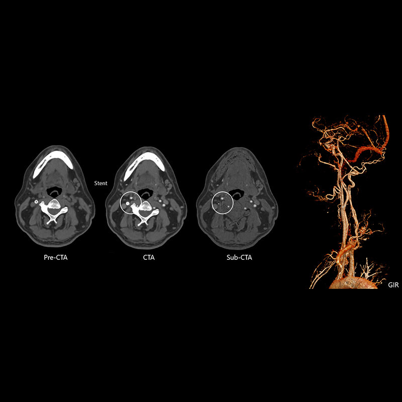 Carotid subtraction CTA Head & Neck 2