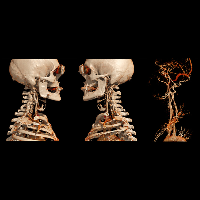 Carotid subtraction CTA Head & Neck 2