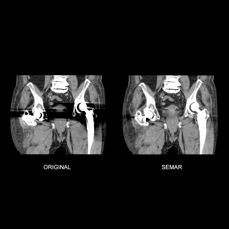 Pelvis with SEMAR Musculoskeletal 3