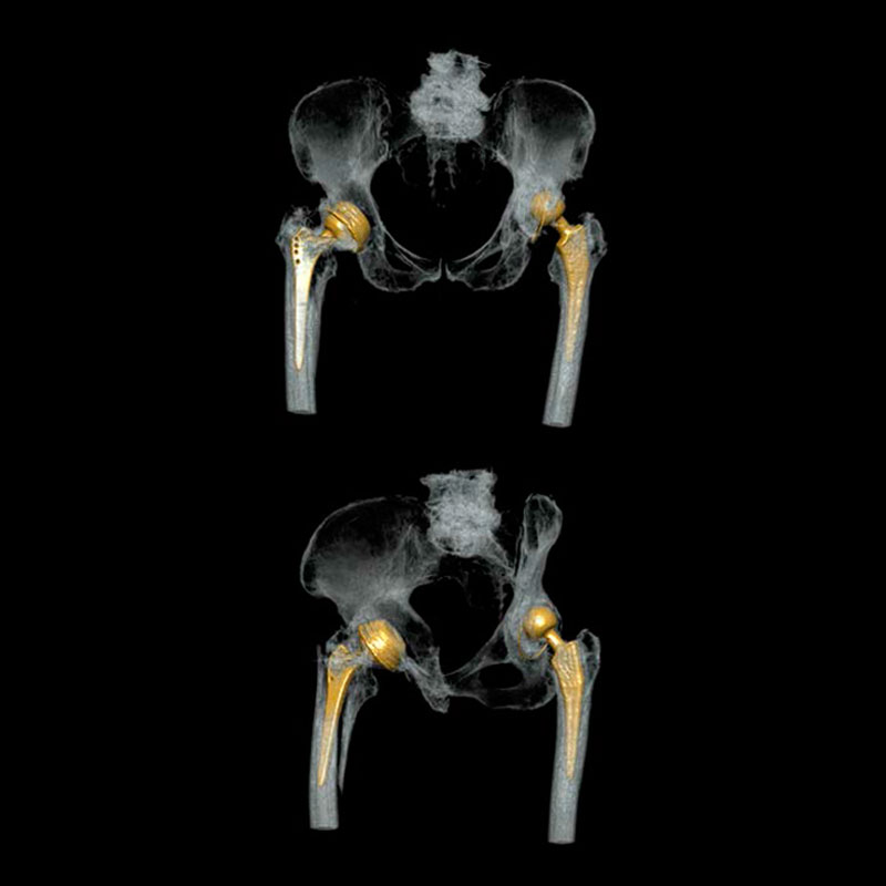 Pelvis with SEMAR Musculoskeletal 3