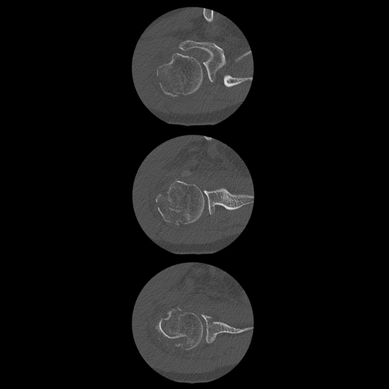 Right Shoulder Musculoskeletal 4