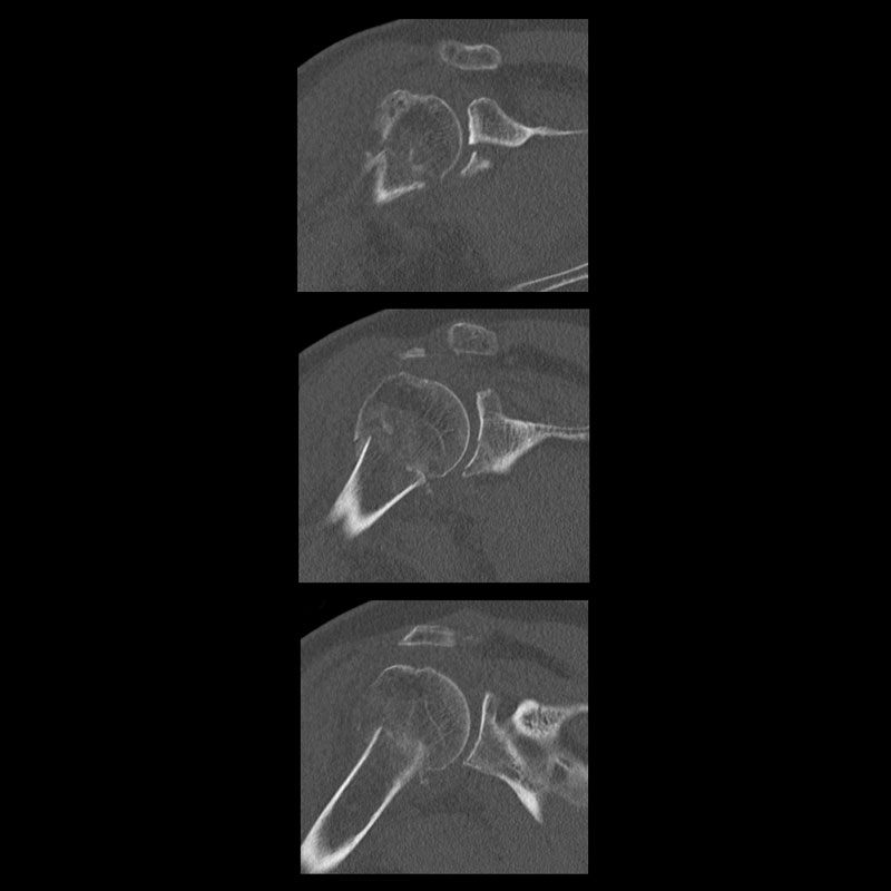 Right Shoulder Musculoskeletal 4