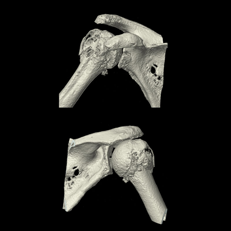 Right Shoulder Musculoskeletal 4