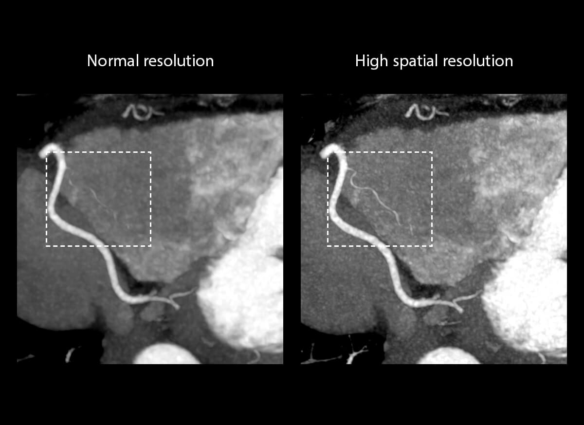 Photon Counting CT Coronary artery2